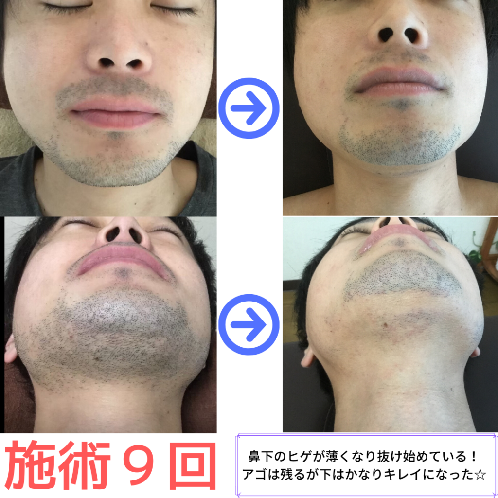 鼻 の 下 の 髭