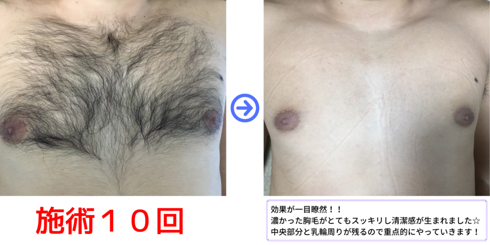 ビフォーアフター 横浜で安い男性脱毛 メンズ脱毛サロンrashindo横浜鶴見店
