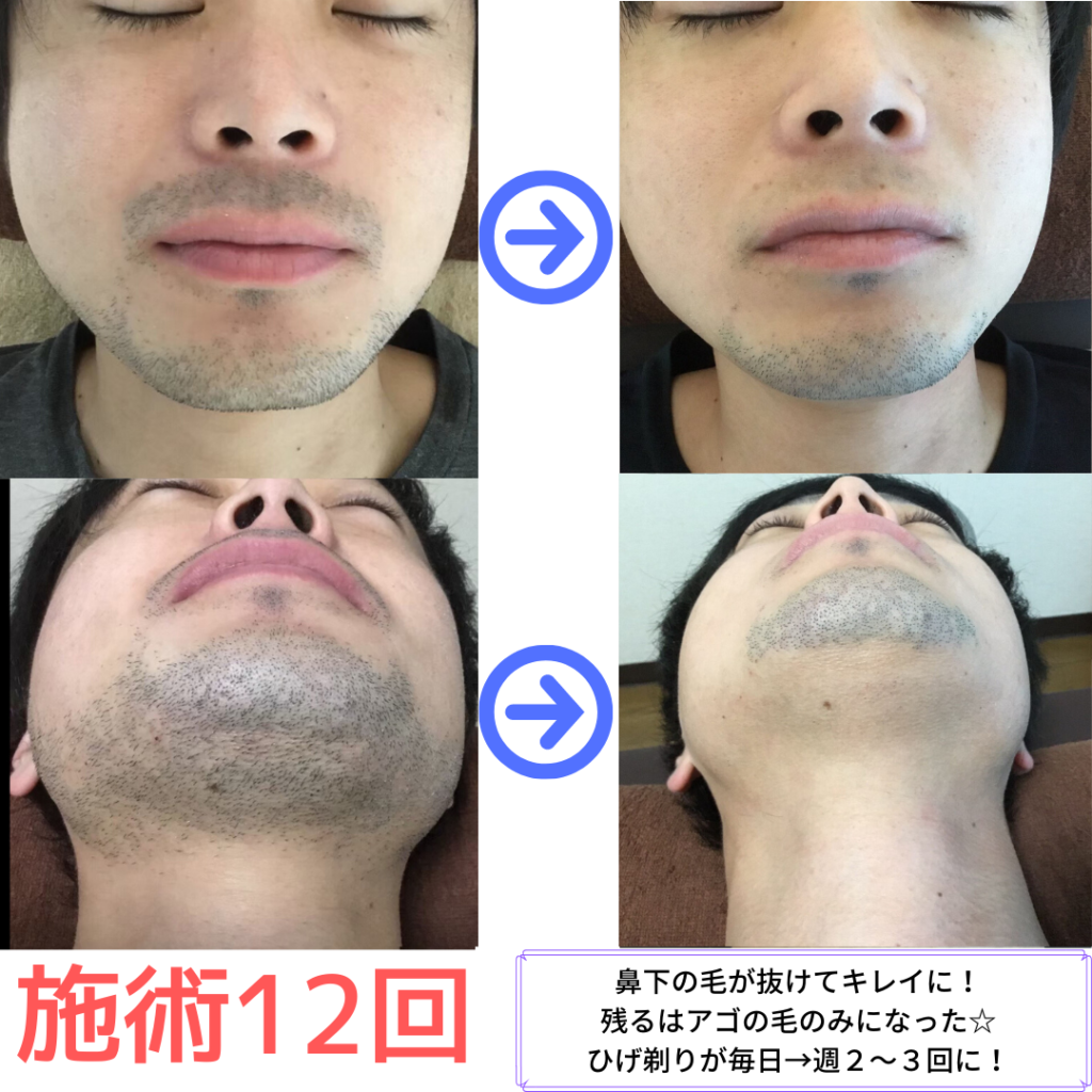 ビフォーアフター 横浜で安い男性脱毛 メンズ脱毛サロンrashindo横浜鶴見店 ビフォーアフター 横浜で安い男性脱毛 メンズ脱毛サロンrashindo横浜鶴見店