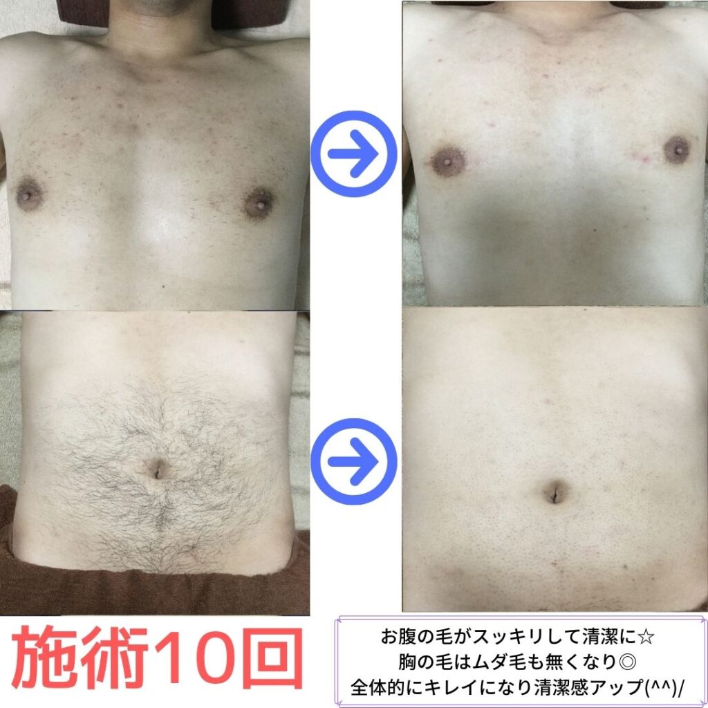 ビフォーアフター 横浜で安い男性脱毛 メンズ脱毛サロンrashindo横浜鶴見店